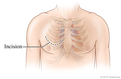 Chest incision site across chest between two ribs