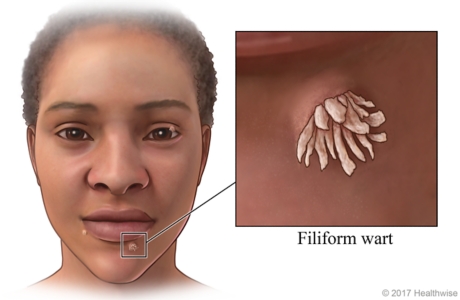 Filiform warts on face, with close-up of wart near bottom lip