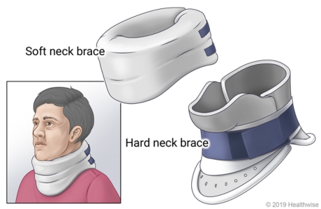 Soft neck brace and hard neck brace, showing person wearing soft neck brace