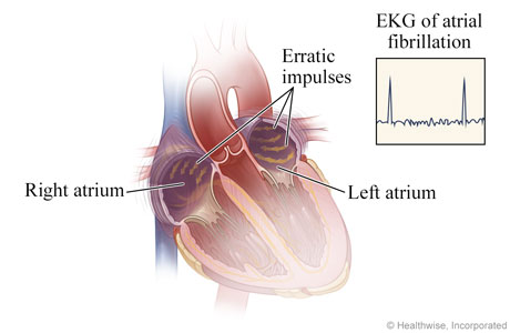 Erratic impulses in heart during atrial fibrillation and resulting EKG