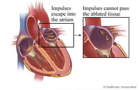 How scar tissue from ablation stops electrical impulses