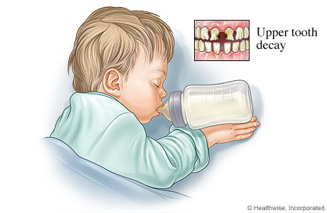 Bottle mouth tooth decay