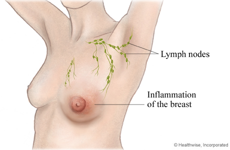 Inflammation of the breast