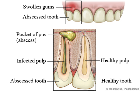 Swollen gums and abscessed tooth, with detail of an abscessed tooth and a healthy tooth