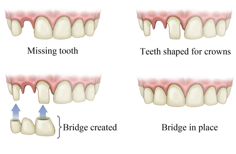 How a bridge is put in for a missing tooth