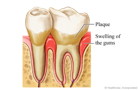 Gum disease around a tooth, showing plaque and swelling of the gums