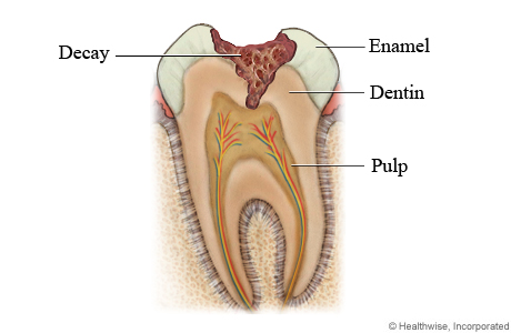Tooth decay through enamel and into dentin
