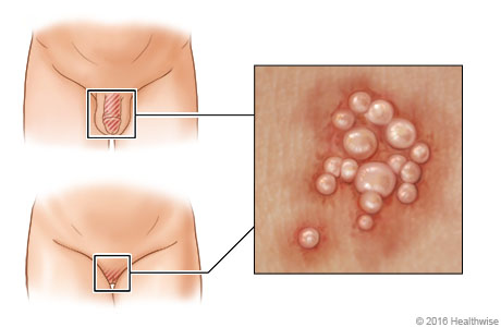 Location of genital herpes in men and women, with close-up of blisters