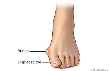 Foot with bunion and displaced toe