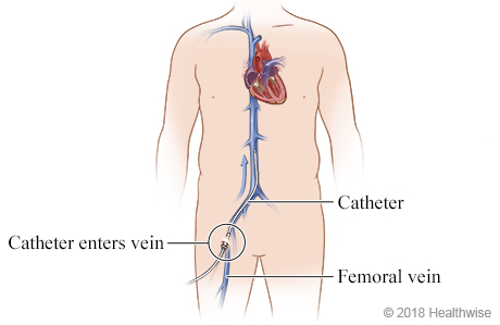 Femoral vein and its location near the groin, where catheter enters vein