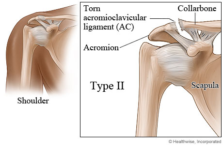 Type II shoulder separation