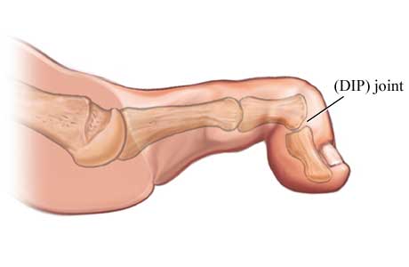 Mallet toe Mallet toe