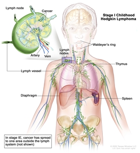 Stage I childhood Hodgkin lymphoma; drawing shows cancer in one lymph node group above the diaphragm. An inset shows a lymph node with a lymph vessel, an artery, and a vein. Lymphoma cells containing cancer are shown in the lymph node.