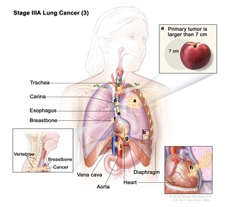 Stage IIIA lung cancer (3); drawing shows (a) a primary tumor (larger than 7 cm) in the left lung and (b) separate tumors in a different lobe of the lung with the primary tumor. Also shown is cancer that has spread to the (c) trachea, (d) carina, (e) esophagus, (f) breastbone, (g) diaphragm, (h) heart, and (i) the aorta and vena cava.