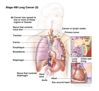 Stage IIIB lung cancer (2); drawing shows a primary tumor in the left lung and (a) a separate tumor in a different lobe of the lung with the primary tumor. Also shown is cancer in lymph nodes on the same side of the chest as the primary tumor. The lymph nodes with cancer are around the trachea or where the trachea divides into the bronchi. Also shown is (b) cancer that has spread to the following: the chest wall and the lining of the chest wall and lung, the nerve that controls the voice box, the trachea, the carina, the esophagus, the breastbone, the diaphragm, the nerve that controls the diaphragm, the aorta and vena cava, the heart, and the sac around the heart.