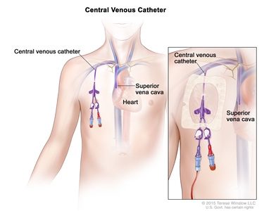Central venous catheter; drawing of a central venous catheter that goes from a vein below the right collarbone to a large vein above the right side of the heart called the superior vena cava. An inset shows a central venous catheter in the right side of the chest with a clear plastic dressing over it.